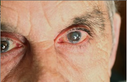 Cataract Treatment